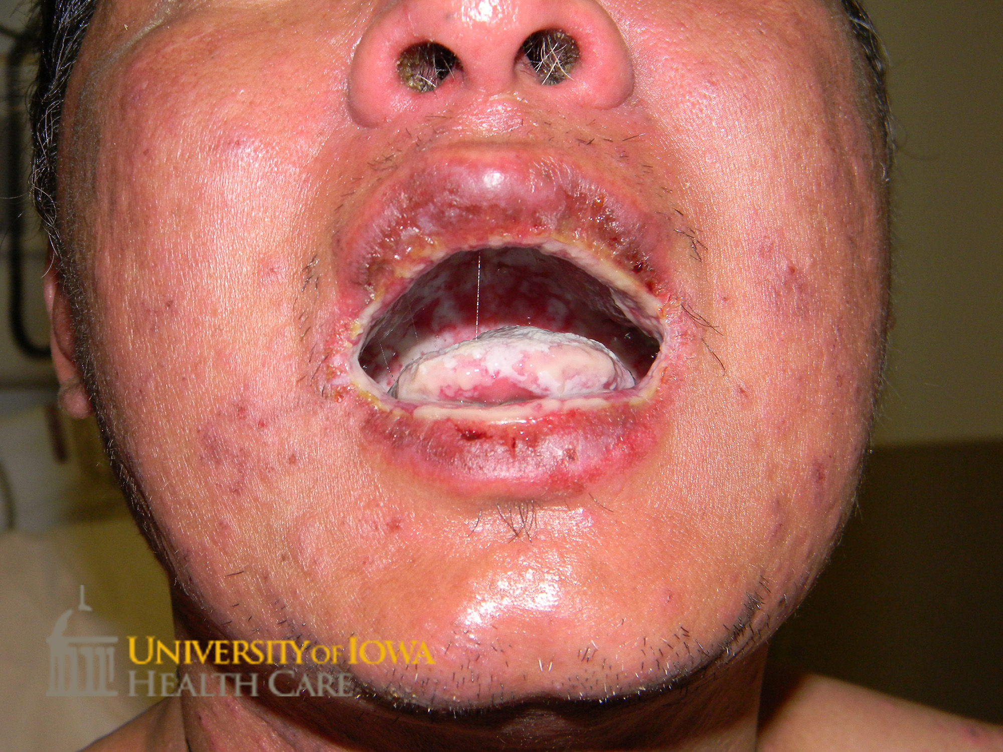 White plaques on the tongue and roof of the mouth with heme crusting of the lips. (click images for higher resolution).